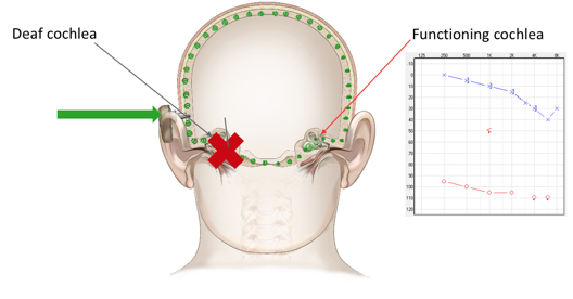 Unilateral Sensorineural Hearing Loss